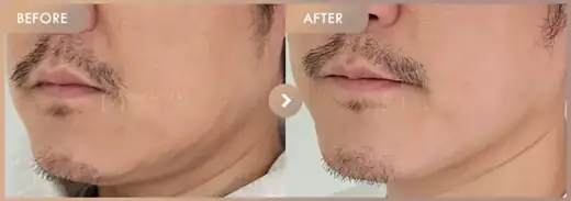 ONDA lifting: before-and-after comparison at Newstar Clinic