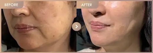 ONDA lifting 3 sessions: before-and-after comparison at Newstar Clinic