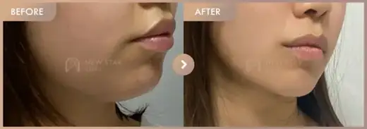 ONDA lifting: before-and-after comparison at Newstar Clinic