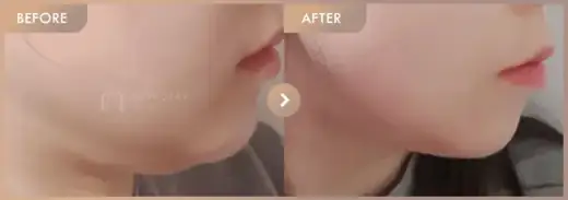 ONDA lifting: before-and-after comparison at Newstar Clinic