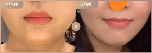 ONDA lifting: before-and-after comparison at Newstar Clinic