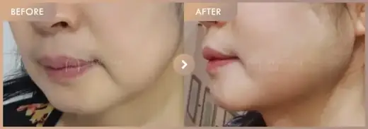 ONDA lifting: before-and-after comparison at Newstar Clinic
