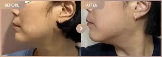 ONDA lifting: before-and-after comparison at Newstar Clinic