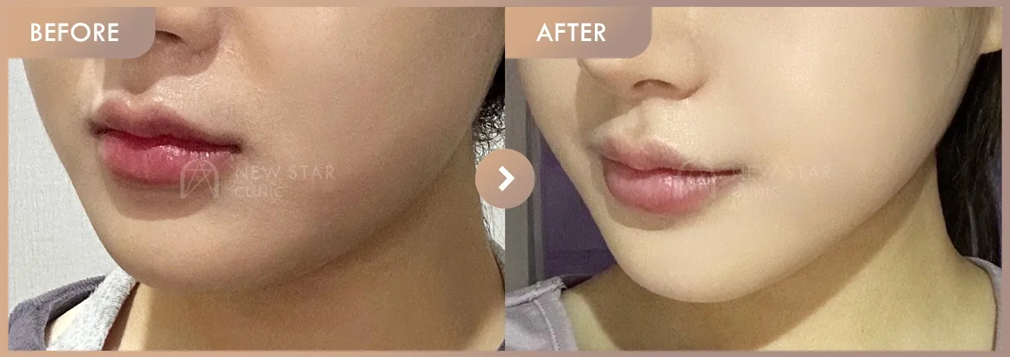 ONDA lifting before-and-after photos at Newstar Clinic