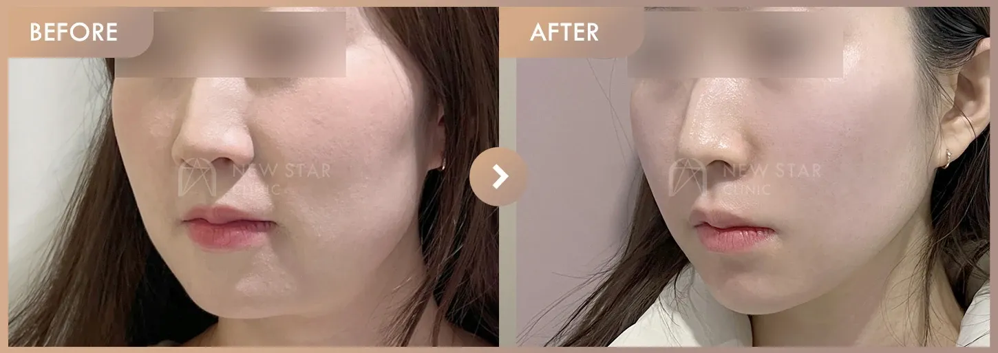 ONDA lifting before-and-after photos at Newstar Clinic