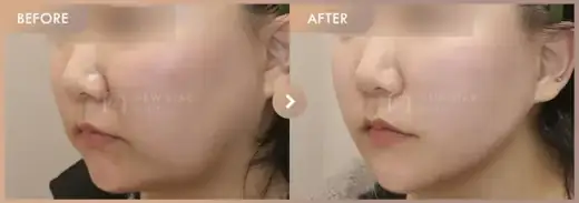 ONDA lifting: before-and-after comparison at Newstar Clinic