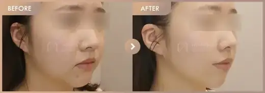 ONDA lifting: before-and-after comparison at Newstar Clinic