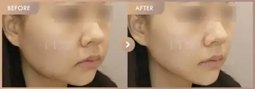Energy-based lifting: before-and-after comparison at Newstar Clinic