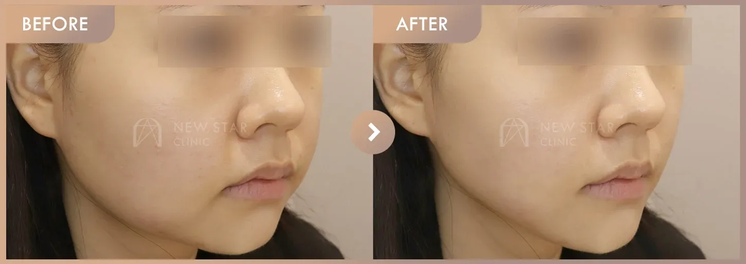 Energy-based lifting before-and-after photos at Newstar Clinic