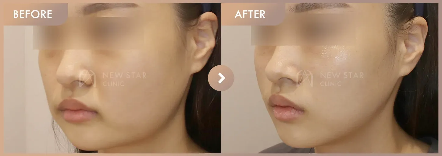 Energy-based lifting before-and-after photos at Newstar Clinic