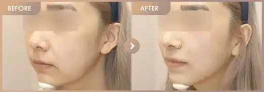 ONDA + Titanium: before-and-after comparison at Newstar Clinic