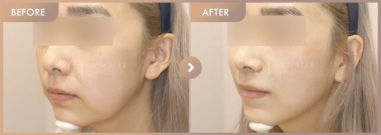 ONDA + Titanium before-and-after photos at Newstar Clinic