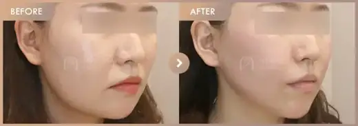 ONDA lifting: before-and-after comparison at Newstar Clinic