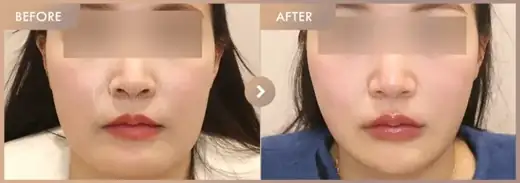 Energy-based lifting: before-and-after comparison at Newstar Clinic