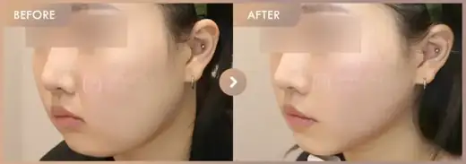 ONDA lifting: before-and-after comparison at Newstar Clinic