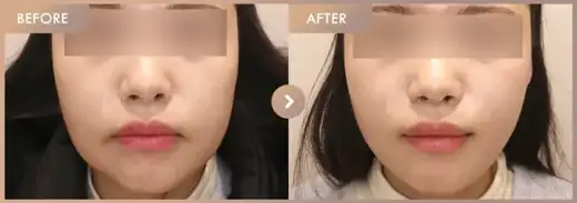 ONDA + Ultherapy: before-and-after comparison at Newstar Clinic