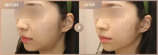 ONDA + Ultherapy: before-and-after comparison at Newstar Clinic
