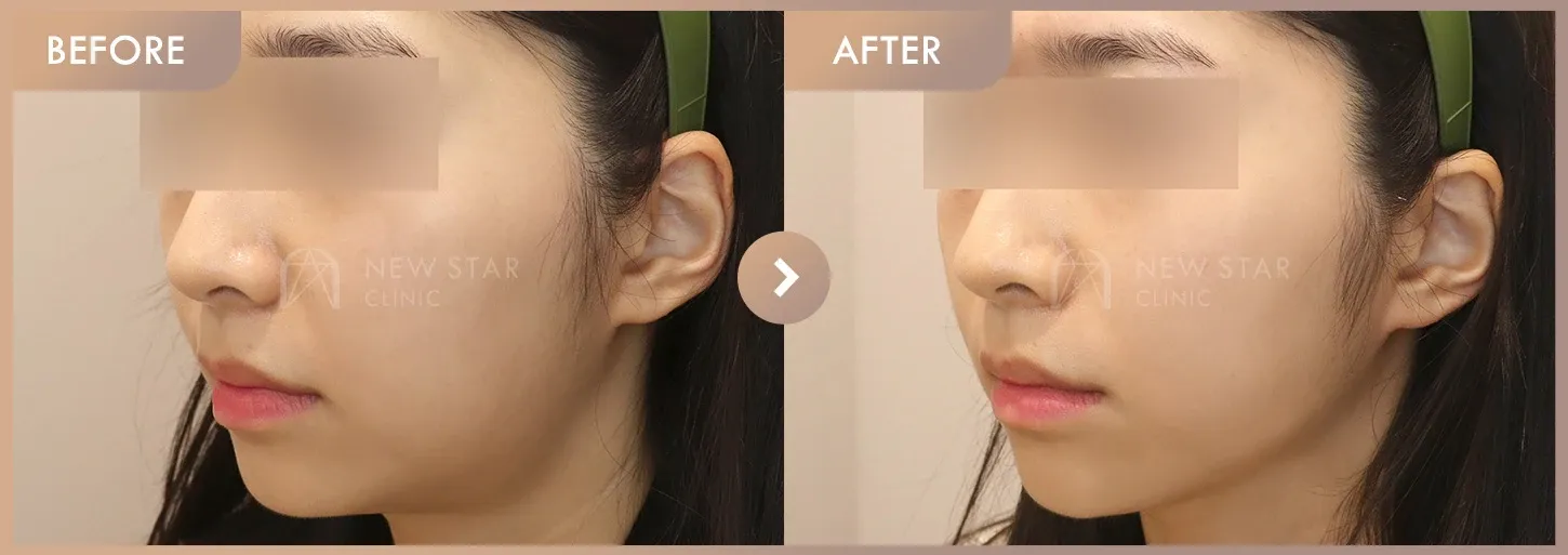 ONDA + Ultherapy before-and-after photos at Newstar Clinic
