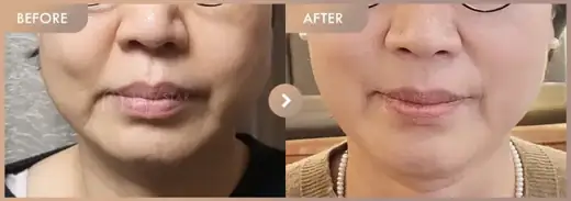 ONDA lifting: before-and-after comparison at Newstar Clinic
