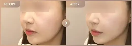 ONDA + Titanium: before-and-after comparison at Newstar Clinic