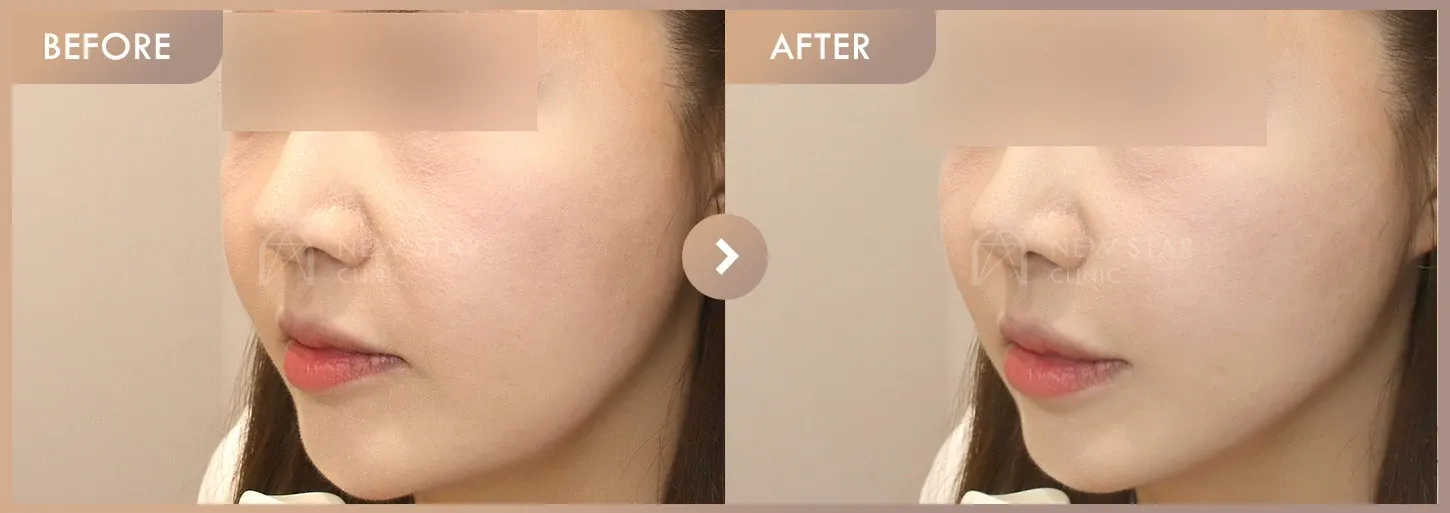 ONDA + Titanium before-and-after photos at Newstar Clinic