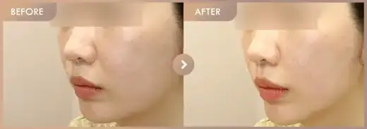 Oligio + ONDA: before-and-after comparison at Newstar Clinic