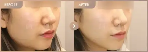 Ultherapy300 + ONDA: before-and-after comparison at Newstar Clinic