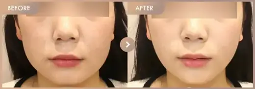 ONDA lifting: before-and-after comparison at Newstar Clinic