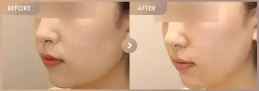 Titanium + ONDA: before-and-after comparison at Newstar Clinic