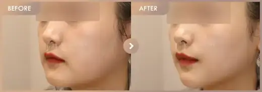 Ruby + CureJet + Juvelook: before-and-after comparison at Newstar Clinic