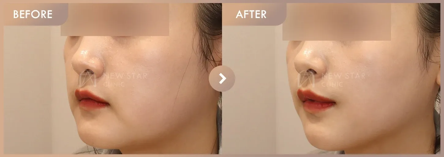 Ruby + CureJet + Juvelook before-and-after photos at Newstar Clinic