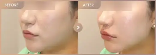 ONDA lifting: before-and-after comparison at Newstar Clinic