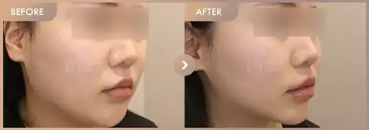 Energy-based lifting: before-and-after comparison at Newstar Clinic