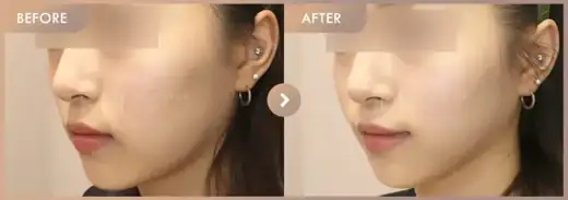 ONDA + Titanium: before-and-after comparison at Newstar Clinic