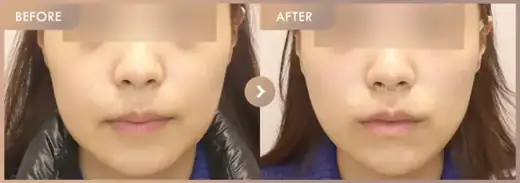 ONDA + Ultherapy 300: before-and-after comparison at Newstar Clinic