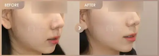 Energy-based lifting: before-and-after comparison at Newstar Clinic