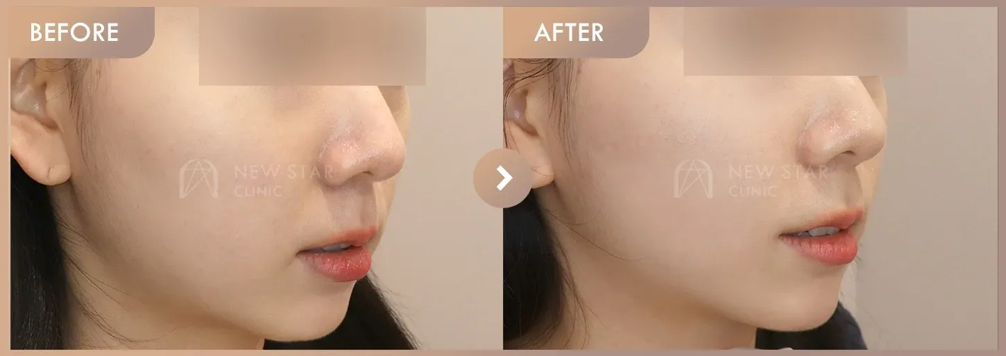 Energy-based lifting before-and-after photos at Newstar Clinic