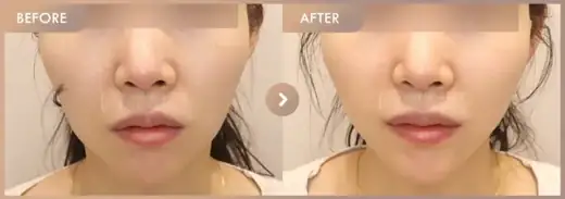 Energy-based lifting: before-and-after comparison at Newstar Clinic