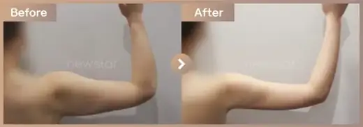 Fat-dissolving injections: before-and-after comparison at Newstar Clinic