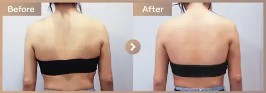 Fat-dissolving injections: before-and-after comparison at Newstar Clinic