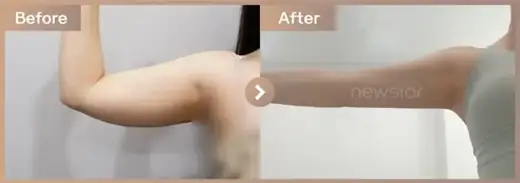 Fat-dissolving injections: before-and-after comparison at Newstar Clinic