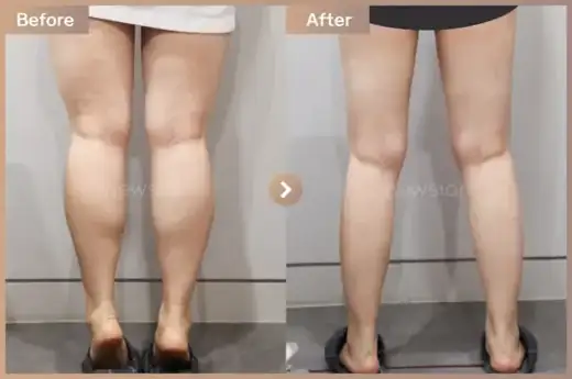 Fat-dissolving injections: before-and-after comparison at Newstar Clinic