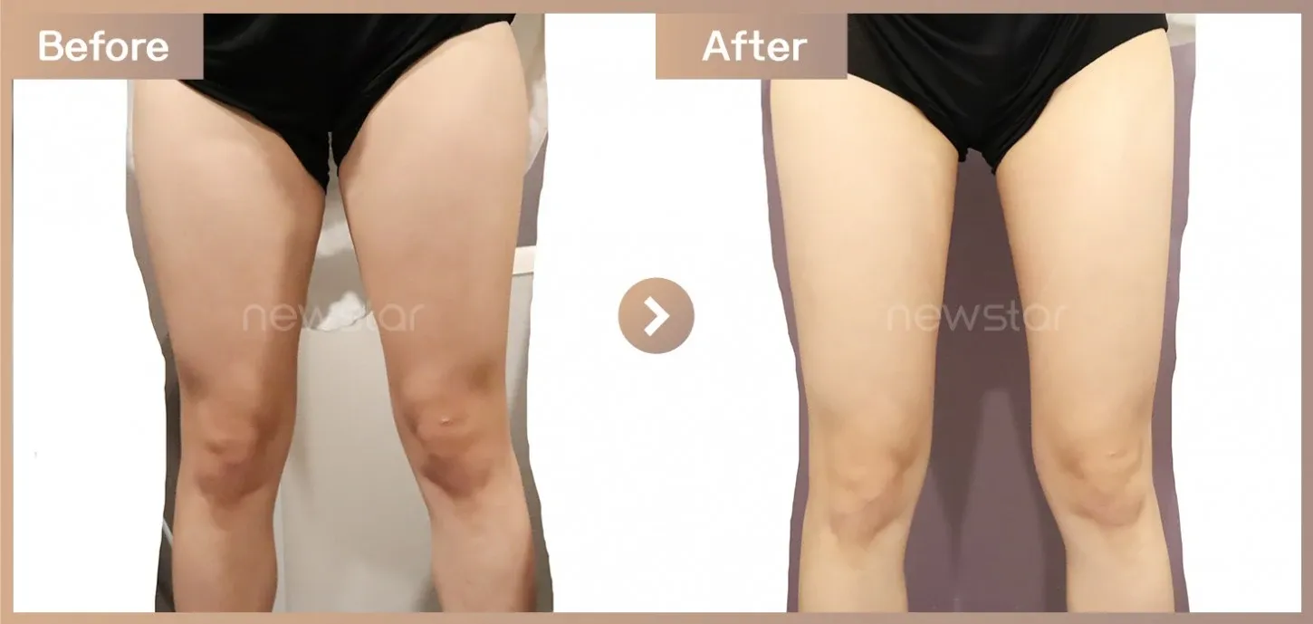 Fat-dissolving injections before-and-after photos at Newstar Clinic