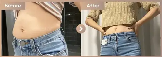 Fat-dissolving injections: before-and-after comparison at Newstar Clinic