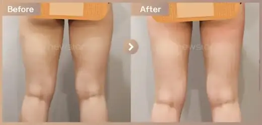 Fat-dissolving injections: before-and-after comparison at Newstar Clinic
