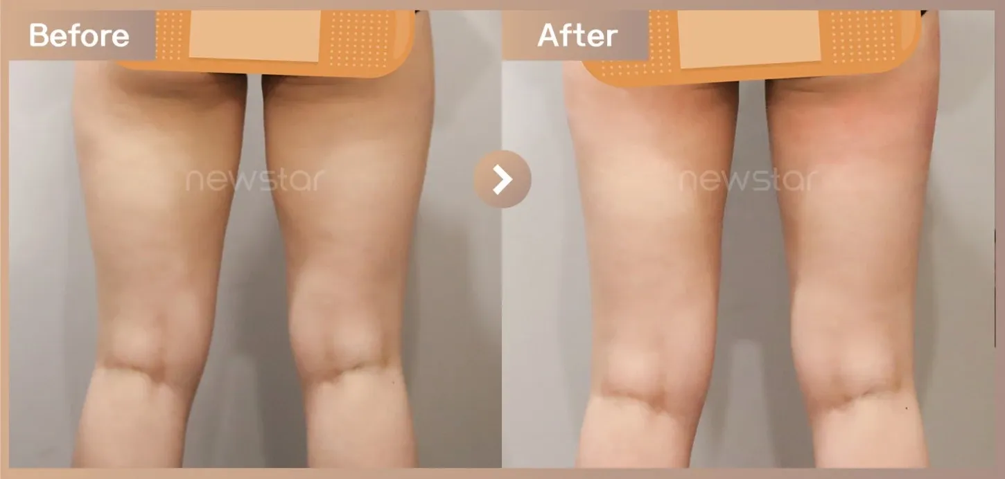 Fat-dissolving injections before-and-after photos at Newstar Clinic