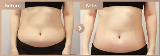 Fat-dissolving injections: before-and-after comparison at Newstar Clinic