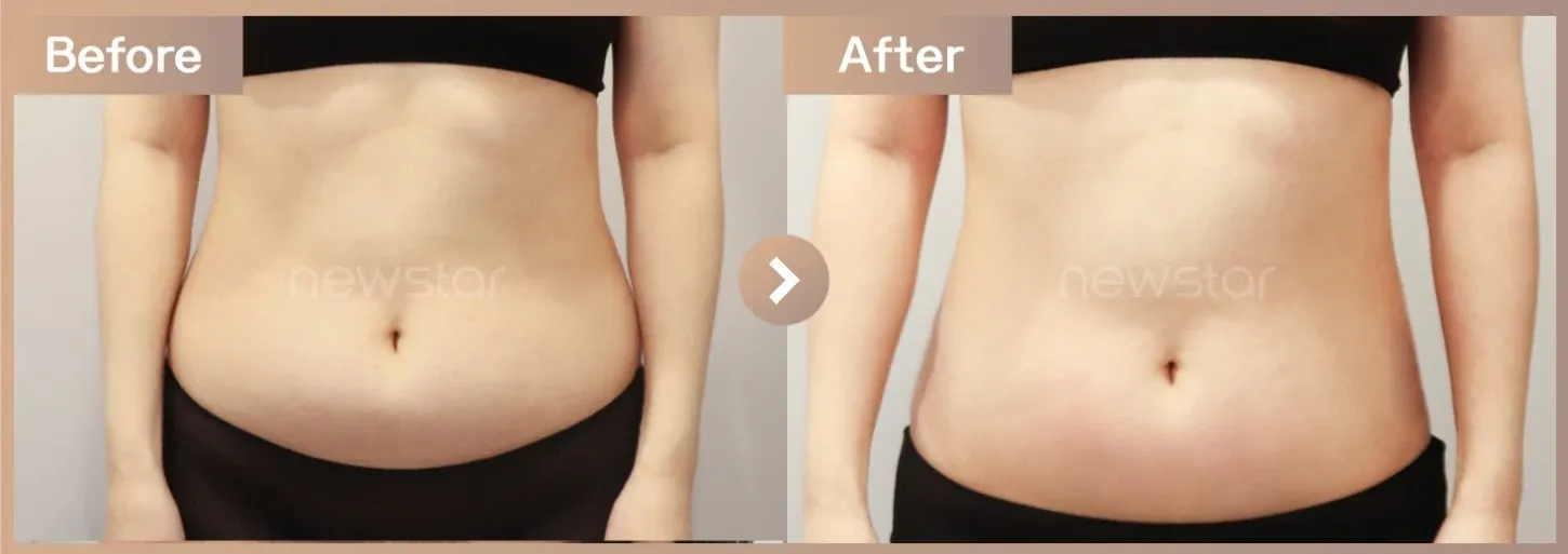 Fat-dissolving injections before-and-after photos at Newstar Clinic