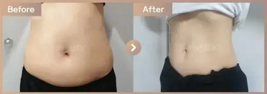 Fat-dissolving injections: before-and-after comparison at Newstar Clinic