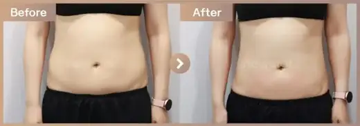 Fat-dissolving injections: before-and-after comparison at Newstar Clinic